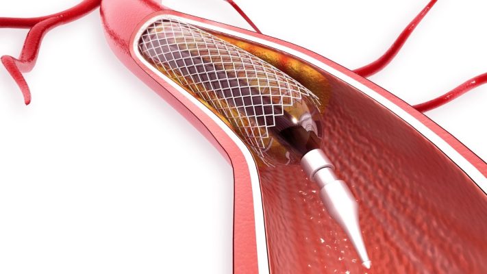 Anjiyo Oldum Bir Daha Kalp Krizi Gecirir Miyim