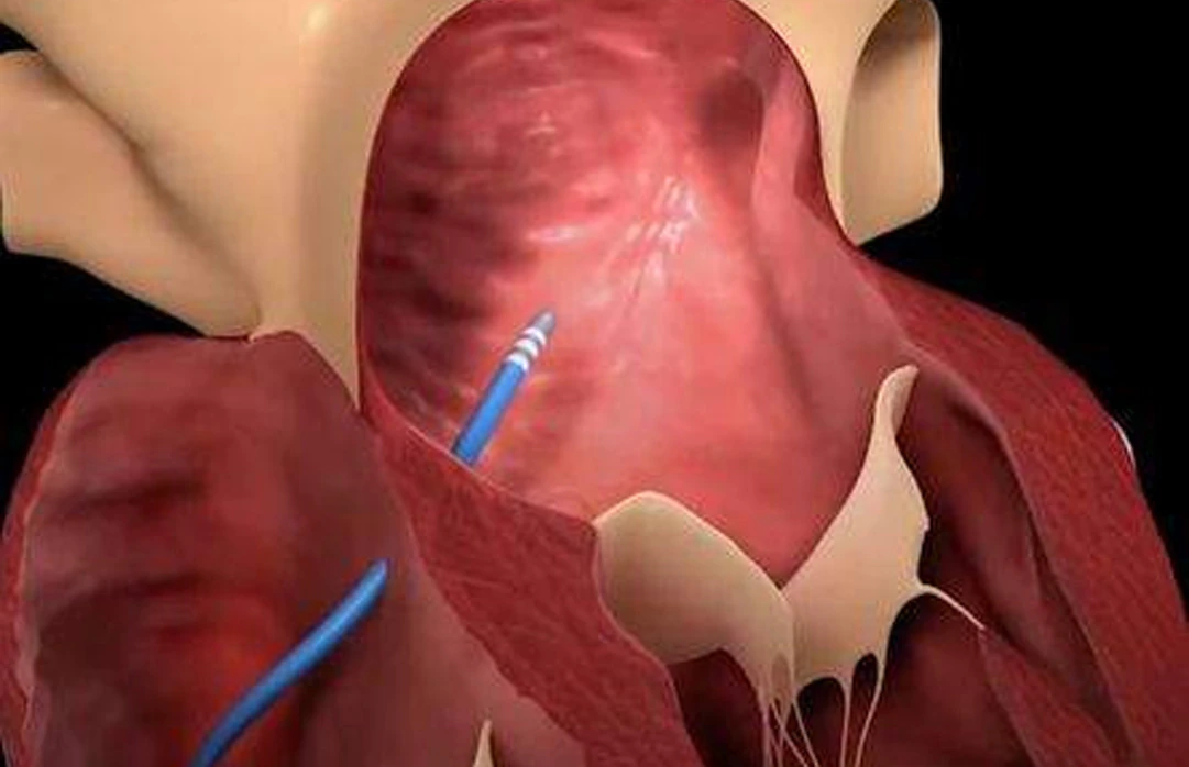 Alkol Septal Ablasyon