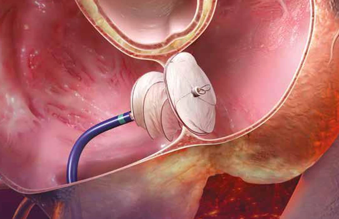 Ameliyatsiz ASD Kapatma