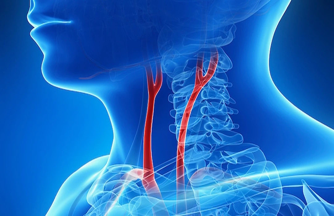 Karotis Arter Sah Damari Hastaligi