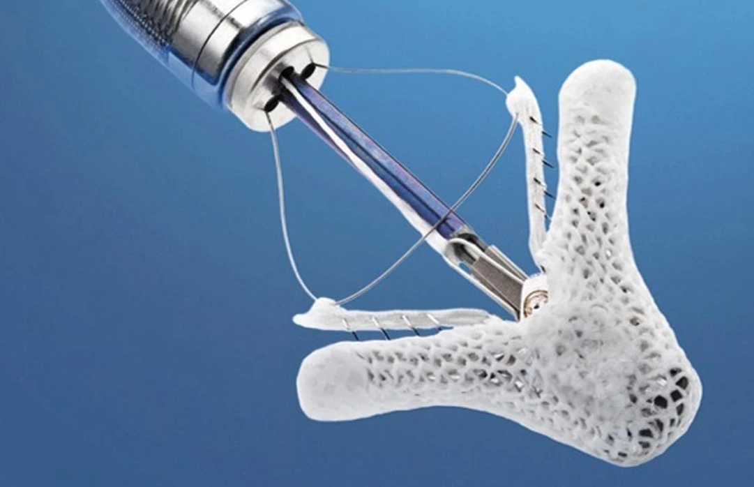 MITRACLIP Ameliyatsiz Mitral Kapak Yetmezligi Tamiri