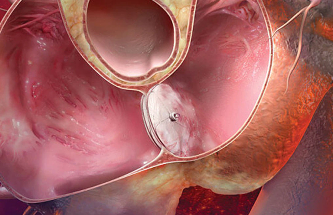 Patent Foramen Ovale PFO Tedavisi