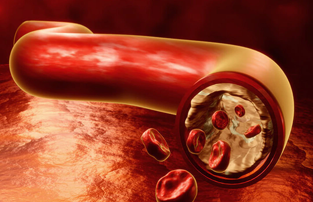 Periferik Arter Hastaliginin Girisimsel Balon ve Stent Ile Tedavisi