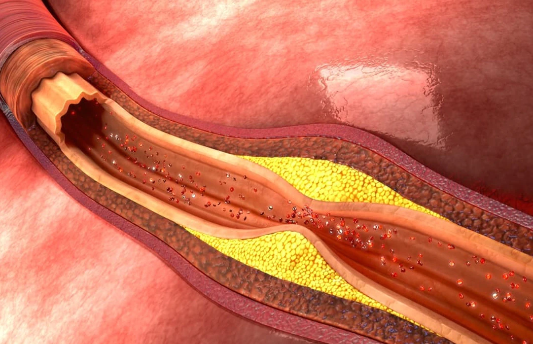 Periferik Damar Hastaligi Tedavisi