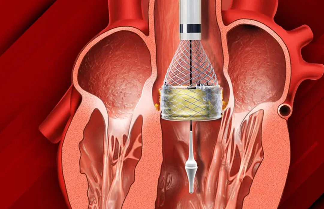 Transkatater Aort Kapak Implantasyonu TAVI