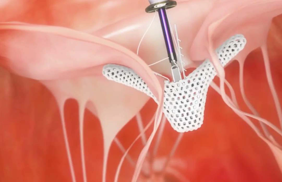 TriClip Ameliyatsiz Trikuspit Kapak Yetmezligi Tedavisi