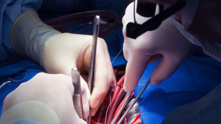 Aort Kapak Replasmani AVR Nedir Nasil Yapilir